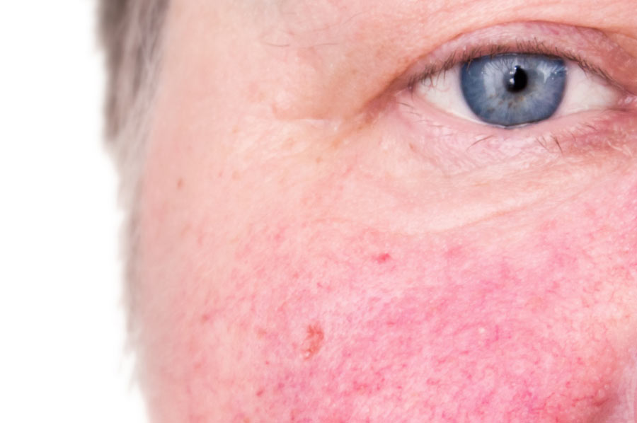 ROSACEA