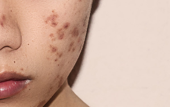 acne
