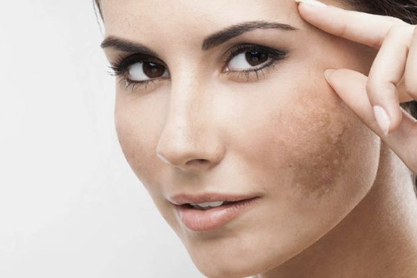 melasma